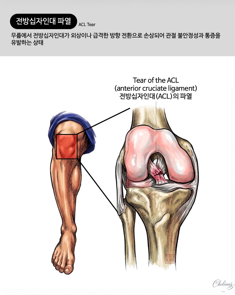 전방십자인대 파열 해부도
