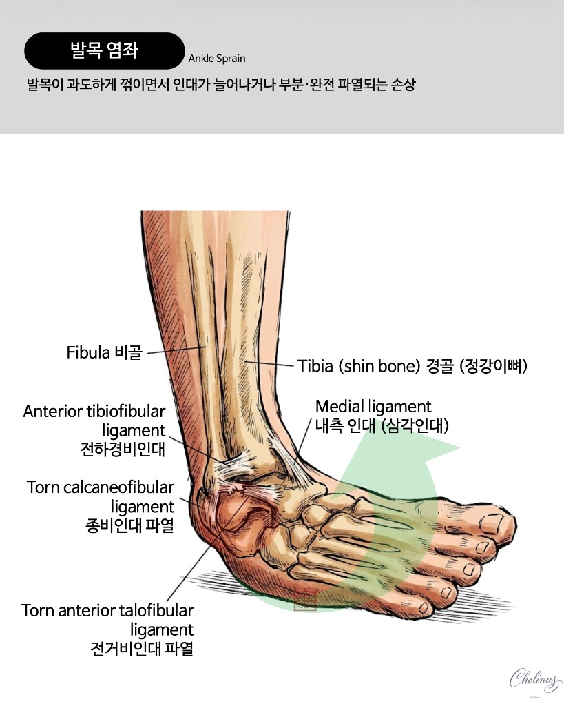발목 염좌 해부도