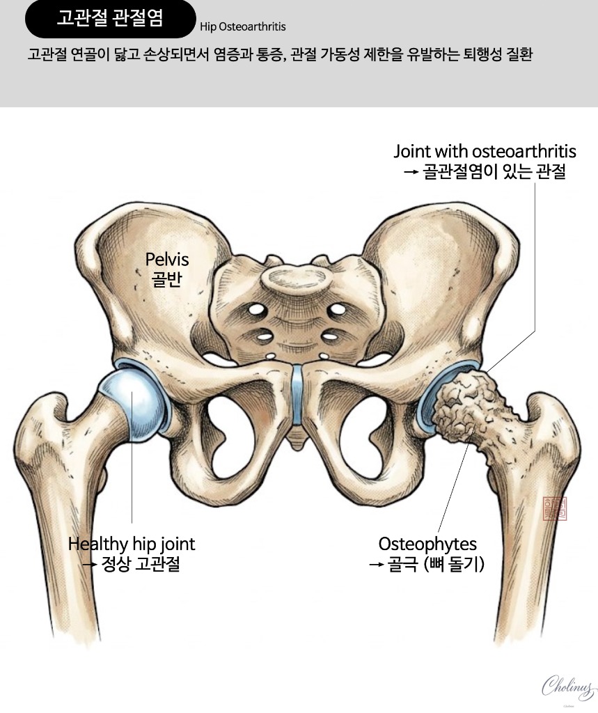 고관절 관절염 해부도