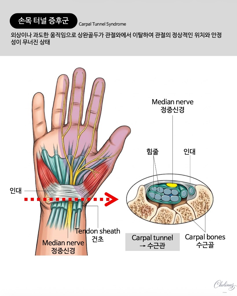 손목 터널 증후군 해부도