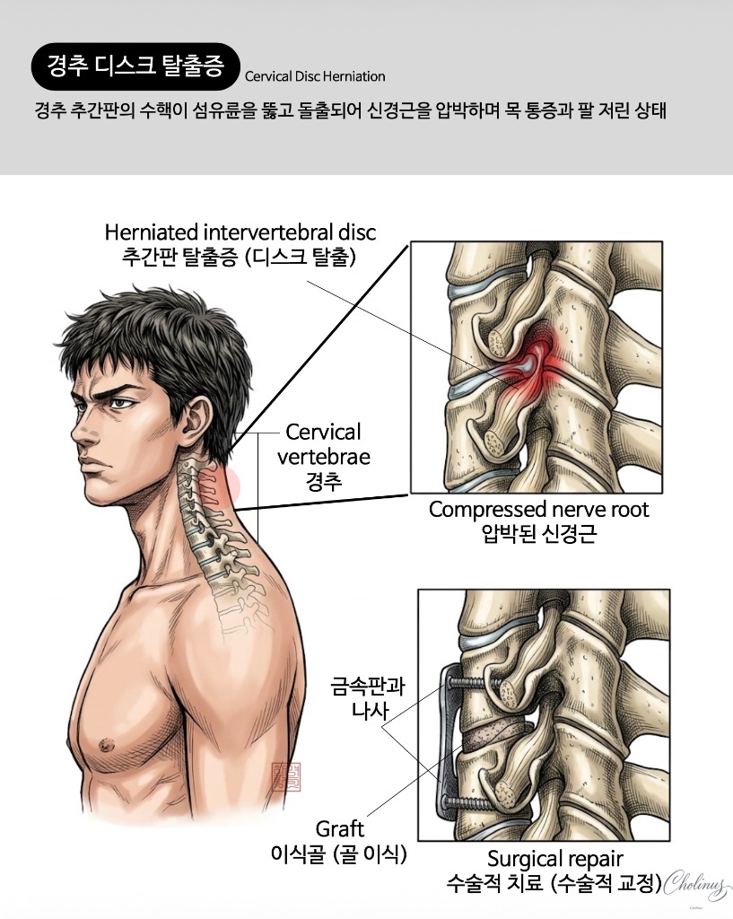 경추 디스크 탈출증 해부도