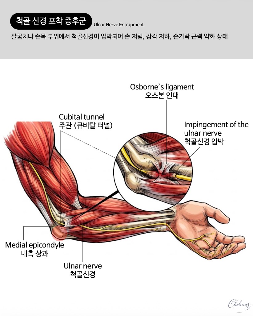 팔꿈치 터널 증후군 해부도
