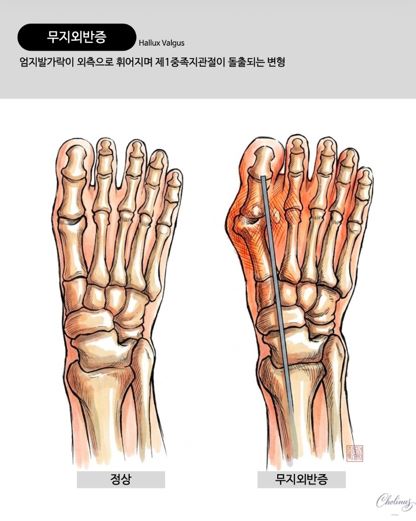 무지외반증1