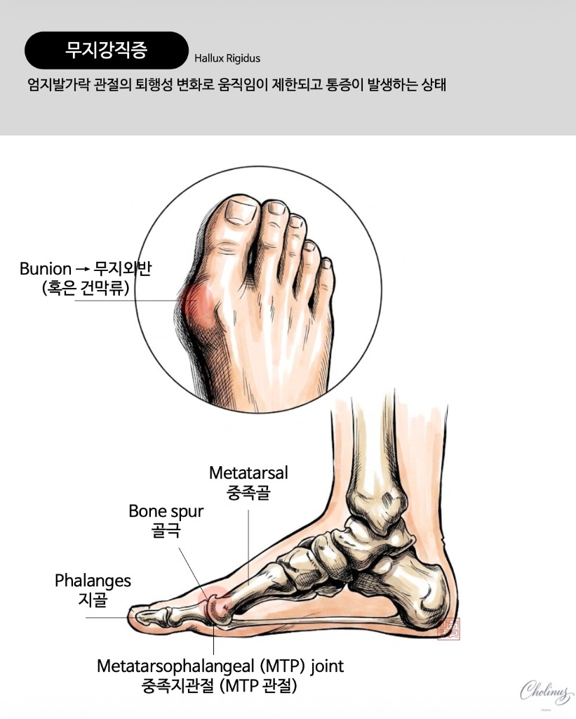 무지외반증2