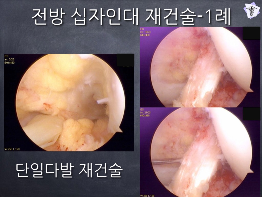 전방 십자인대 단일다발 재건술 1례