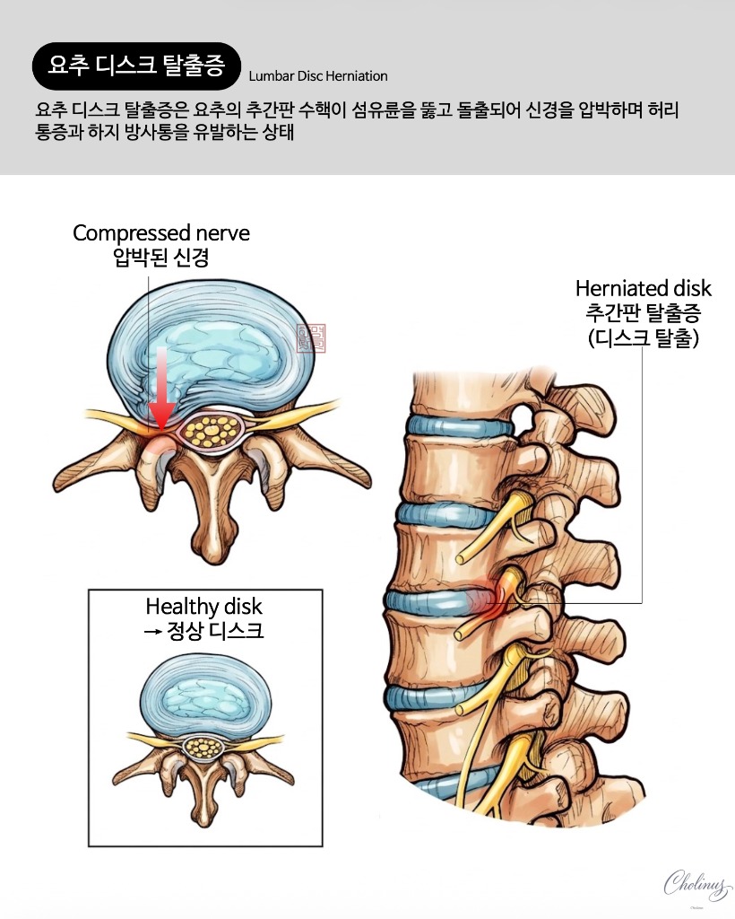 요추 디스크 탈출증 해부도