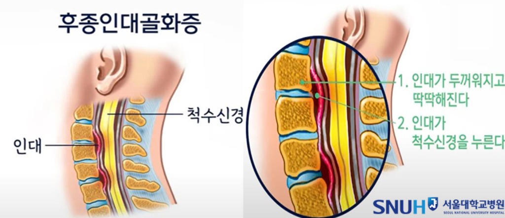 후방인대골화증 해부도