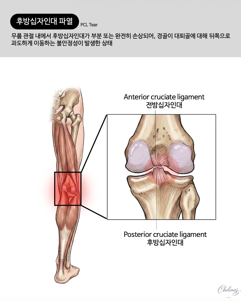 후방십자인대 파열 해부도