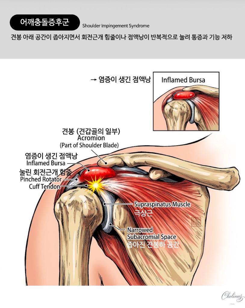 회전근개 건염 해부도