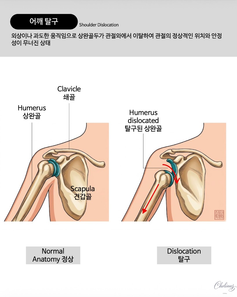 다발성 어깨 불안정증 해부도