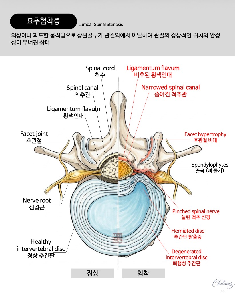 척추간 협착증 해부도