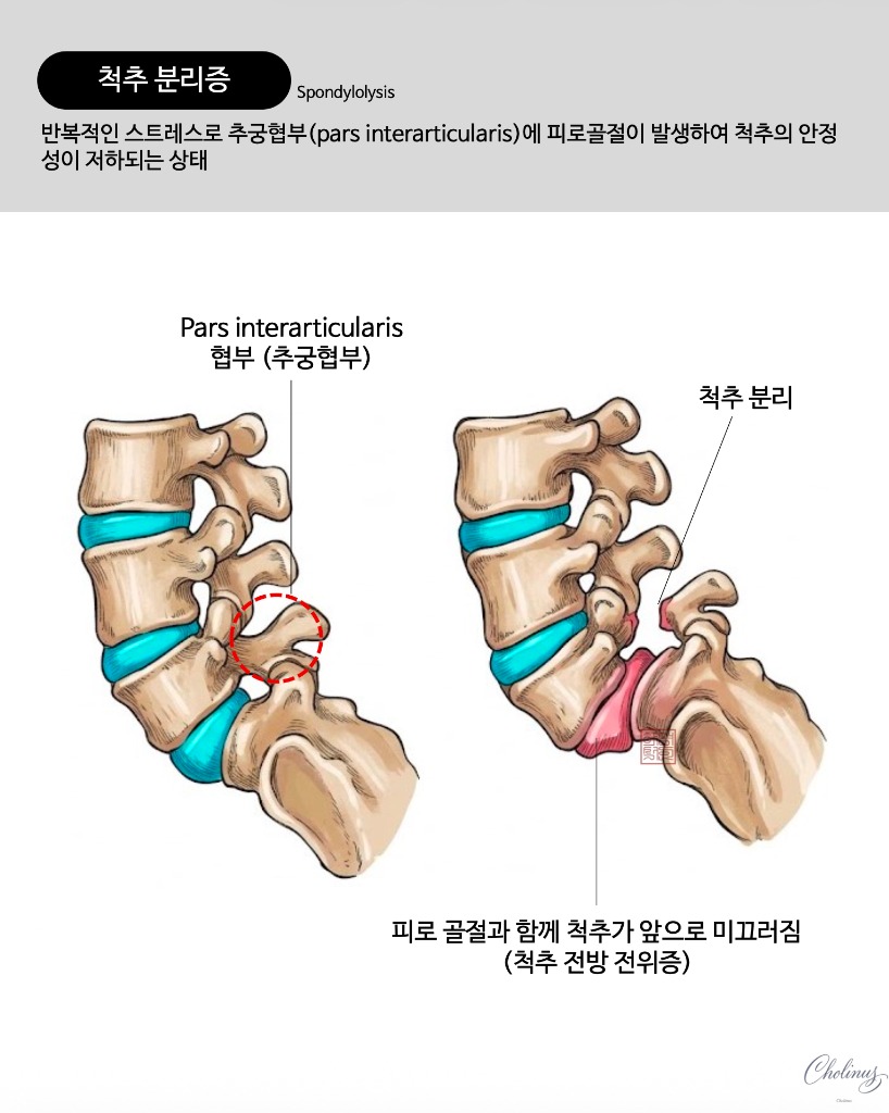 척추전방전위증 및 척추분리증 해부도