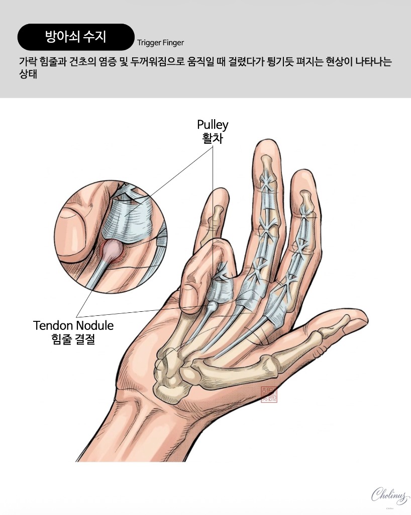 방아쇠 손가락 해부도