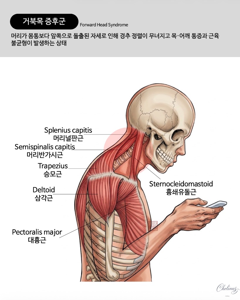 거북목 증후군 해부도
